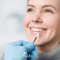 Dental Veneers in Los Algodones: What the Price Per Tooth Leaves Out?